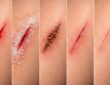 découvrez les différentes étapes de guérison d'une blessure causée par une araignée couteau et apprenez comment favoriser une récupération rapide et efficace.