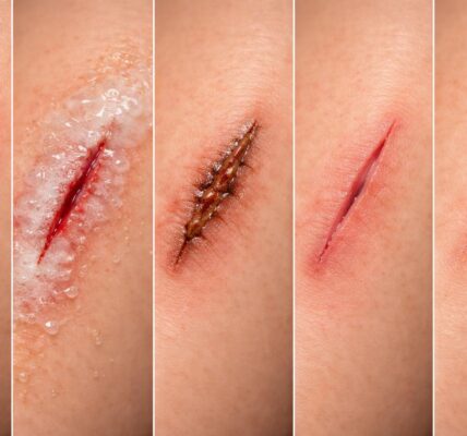 découvrez les différentes étapes de guérison d'une blessure causée par une araignée couteau et apprenez comment favoriser une récupération rapide et efficace.
